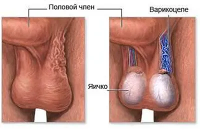 Варикоцеле: причины, симптомы и лечение в Клинике АльтраВита