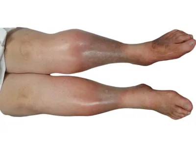 ФЛЕБОЛОГ АЛМАТЫ | АТЫРАУ | БИШКЕК on Instagram: \"Флеболог всегда отображает  то, что видит на ногах, опираясь на всемирную классификацию клинических  проявлений варикоза. Замечали ли вы, что при постановке диагноза ставится  буковка \"