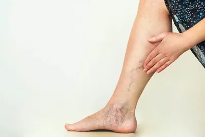 Варикозное расширение вен: что это, причины, симптомы, методы лечения и  профилактика варикоза ног