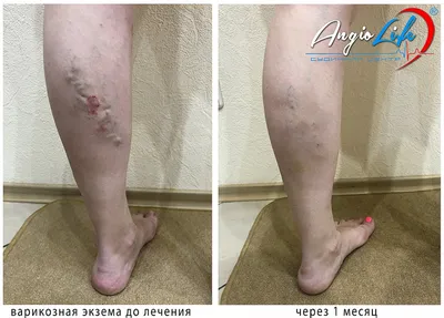 Leg ulcers photos | Before and after treatment Kyiv Zaporozhye