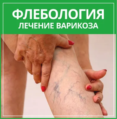 Как лечить варикоз на ногах и опасны ли сосудистые сеточки и звездочки - 30  июля 2022 - 63.ru