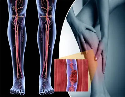 Варикоз на ногах: симптомы у женщин и мужчин, причины расширения вен,  лечение