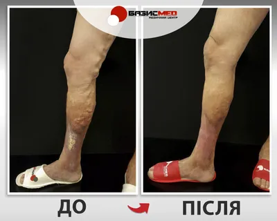 Лечение варикозной болезни нижних конечностей в Сочи | Центр флебологии и  лазерной хирургии