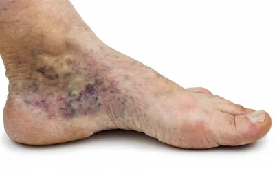 Варикозное расширение вен на ногах - симптомы, стадии варикоза вен нижних  конечностей и лечение в клинике \"СОЮЗ\"