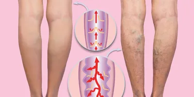 Варикоз - что это, симптомы заболевания, типы, диагностика и лечение