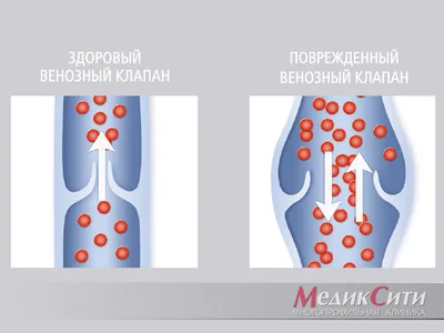 Варикоз 1–2 степени: симптомы и причины развития. Полезные статьи о  флебологии