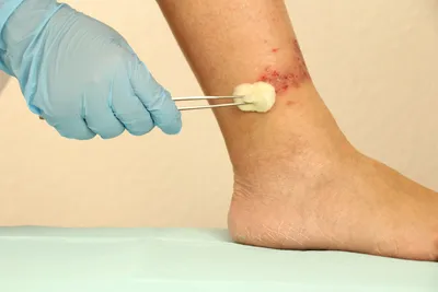 Варикозный (венозный) дерматит на ногах - лечение | Медицинский центр  ФлебоПлюс