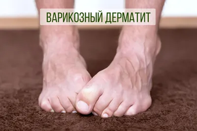 Лечение варикозной трофической язвы на ноге в Москве