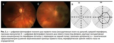 Рис. 1. a – цифровая фотография глазного дна правого глаза (эксс…