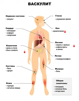 Геморрагический васкулит — 10 ответов | форум Babyblog