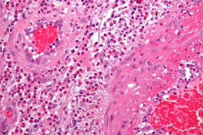 Image: Иммуноглобулин А-ассоциированный васкулит (пурпура Шенлейн-Геноха)  (Ноги) - Справочник MSD Профессиональная версия