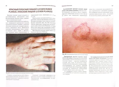 Венерические заболевания кожи фото фото