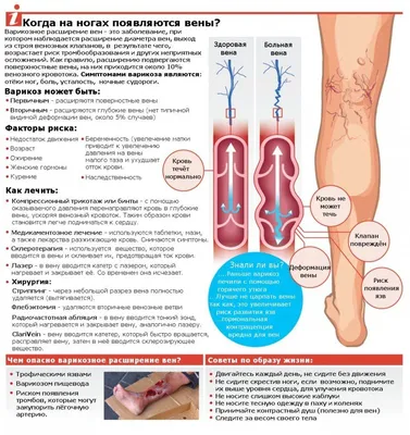 От варикоза можно избавиться без операции! - Hisar Intercontinental Hospital