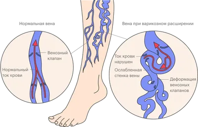 Как лечить сосудистые звёздочки - «Институт Вен» лечение варикоза в Киеве и  Харькове