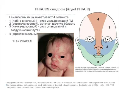 ДИАГНОСТИКА И ЛЕЧЕНИЕ МЛАДЕНЧЕСКИХ ГЕМАНГИОМ