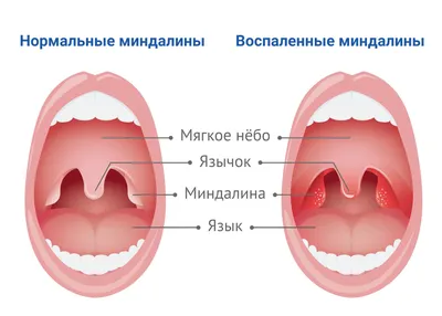 Ответы Mail.ru: Болит мягкое нёбо (p.s тут очень некрасивая картинка )