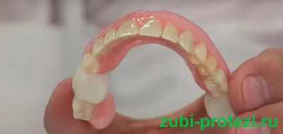 Виды зубных протезов без нёба, удобные съёмные протезы