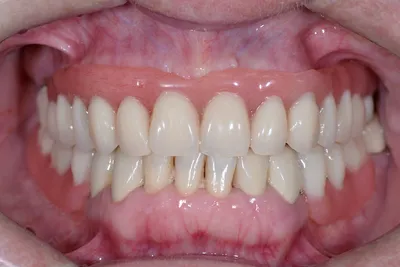 Съемные зубные протезы - полезные статьи стоматологической сферы в блоге  «Гелиоса».