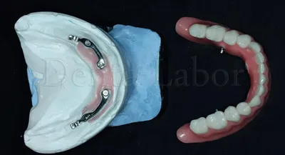 Зубное протезирование Кривой Рог. Установка протезов, коронки на зуб.