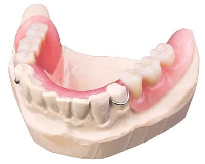 Зубные протезы на нижнюю челюсть: цены на частичное и полное протезирование  | НоваДент