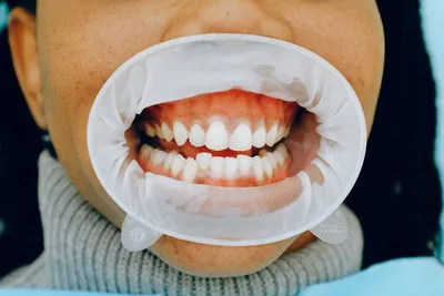 Виды съемных зубных протезов – частичные, полные и на два зуба:  искусственное протезирование челюсти на крючках и ее установка – как  крепится, ставится, делается и что это такое