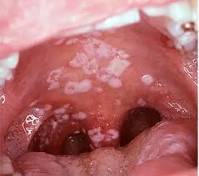 Лейкоплакия полости рта: симптомы, дифференциальная диагностика, виды и  лечение