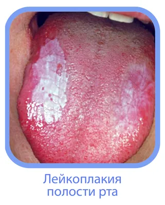 Эрозии полости рта — Стоматология «Доктор НеболитЪ»