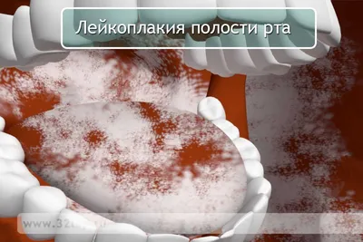 Лейкоплакия полости рта в Минске по приятным ценам