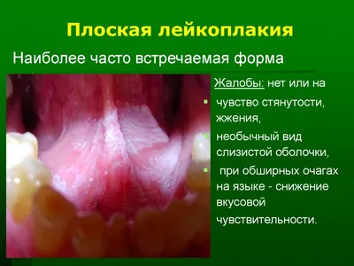 Лейкоплакия полости рта - ГБУЗ ЯНАО