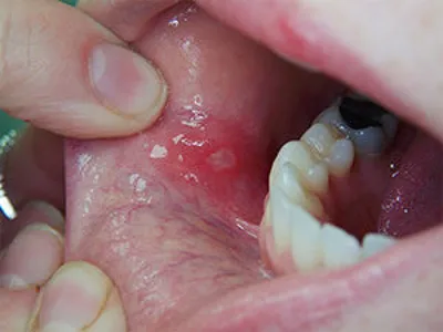Лейкоплакия полости рта: симптомы, дифференциальная диагностика, виды и  лечение