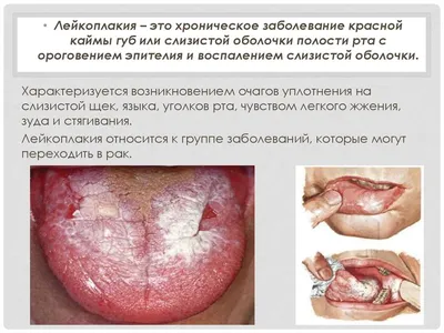 Клинический случай комплексного лечения веррукозной формы лейкоплакии  слизистой оболочки рта с применением лазерной абляции и препаратов на  основе коллагена - Медалфавит