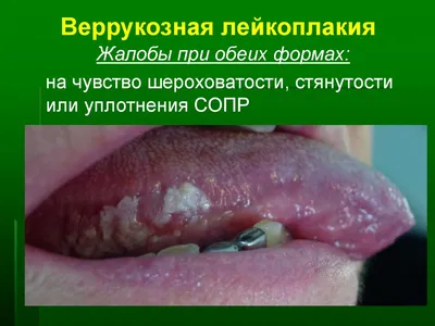 Клинический разбор случаев проявления красного плоского лишая в полости рта  - Клинический разбор в общей медицине №06 2021 - CON-MED.RU