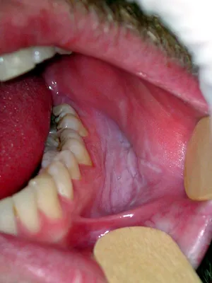 Клиника Сатори в Самаре - Лейкоплакия – хроническое воспалительное  заболевание слизистых оболочек полости рта. Характеризуется утолщением и  чрезмерным ороговением эпителия. Это проявляется появлением на слизистой  белых или сероватых пятен с четкими ...
