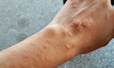 пухлые волдыри на коже, вызванные укусами комаров на бедре Стоковое  Изображение - изображение насчитывающей лихорадка, цыпк: 219300881