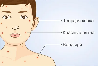 Как лечить болячки в волосах на коже головы | Блог IHC Clinic