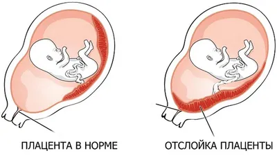 Бесплодие после аборта: вероятность риска и лечение