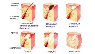 Акне: что это такое и каковы причины возникновения заболевания?