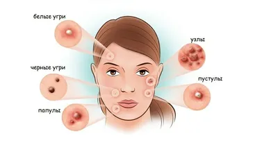 красивая молодая женщина и виды акне. изолированная девочка-подросток с  плохой кожей лица. инфекционная сыпь и мышление Иллюстрация вектора -  иллюстрации насчитывающей чисто, клетка: 230277303