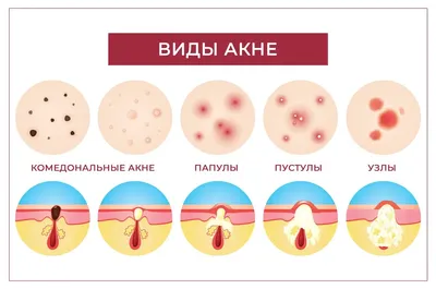 Клиника лечения акне в Москве - запись к дерматологу ☎