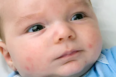 Аллергия у новорожденного. Что нужно знать? | Школа мам Nutrilak | Дзен