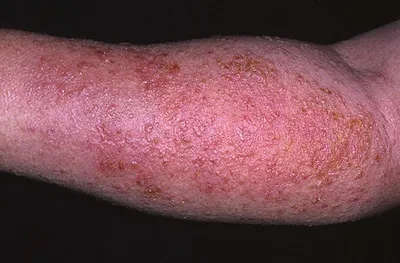 Аллергия на коже: симптомы и причины | Диагностика и лечение кожной  аллергии в АО «Медицина»