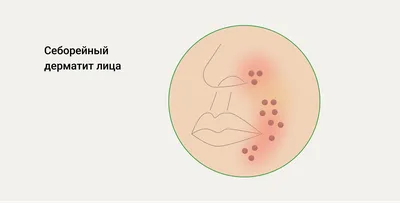 Лечение псориаза на голове