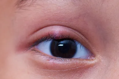 Халязион на глазу — причины, симптомы, лечение