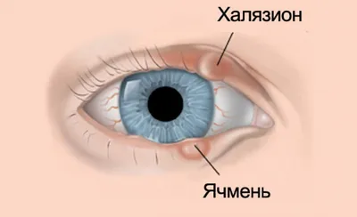 Причины и симптомы появления ячменя | блог Хирургия глаза