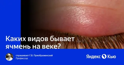 Почему появляется ячмень, как его избежать и как лечить, если выскочил