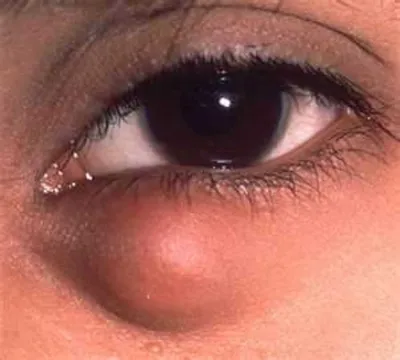 Отек глаз (век) - причины, лечение, что делать, симптомы, признаки, степени