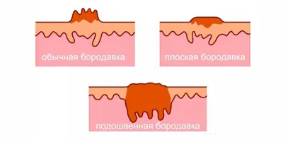 ВПЧ — вирус папилломы человека: симптомы и проявления, причины заражения,  лечение