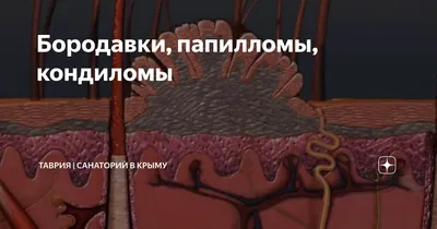 Удаление анальных кондилом, виды и особенности, диагностика, лечение и  профилактика — Клиника «Доктор рядом»