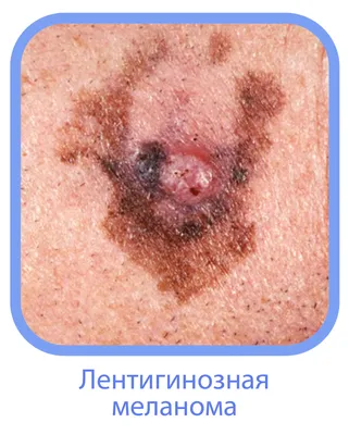 Меланома кожи: симптомы, классификация, стадии, прогноз, диагностика и  методы лечения меланомы кожи