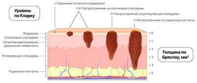 Онко Вики — Формы меланомы